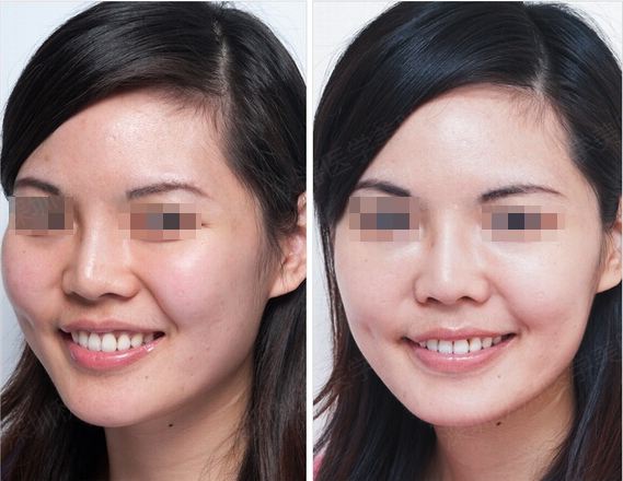 打美白针有没有什么危害呢