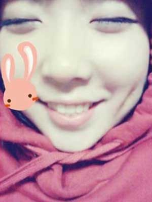 酒窝成形术对比照 我有小酒窝