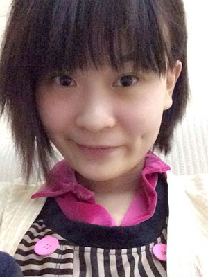 酒窝成形术对比照 打造甜美系女生