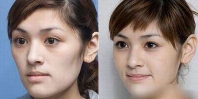 颧骨手术对比照 摆脱克夫脸