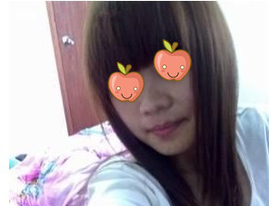 激光去痣 变美不是罪过