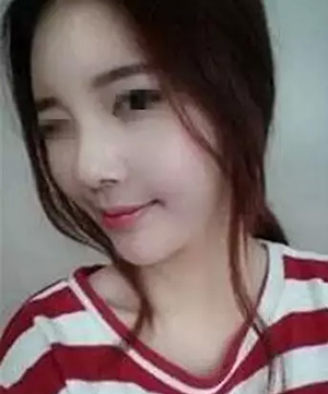 注射额头鼻子 让自己五官立体起来了