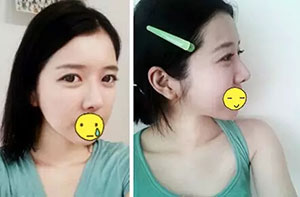 双眼皮+隆鼻 从小清新变成韩系甜美美眉