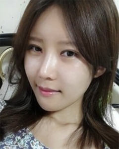 隆鼻+眼部整形+下巴矫正  变精致美女