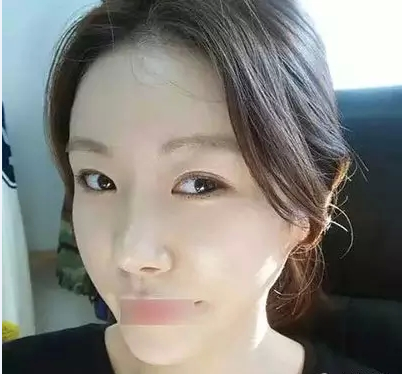 双眼皮+隆鼻+全脸脂肪移植 想要美一切皆有可能