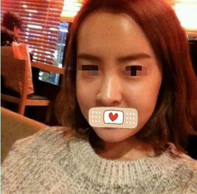 去眼袋  美的感觉不一样了