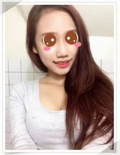 肉毒素瘦脸+玻尿酸丰下巴 变性感女神