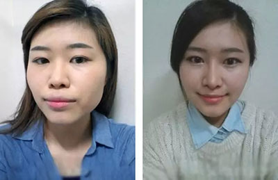 面部整形 从汉子变女神