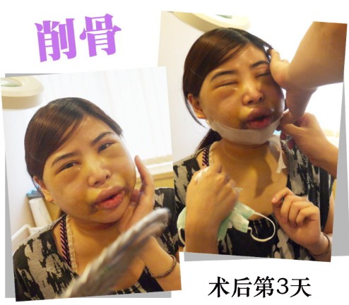 削骨整形 逆袭成回头率百分百 - 珍美网