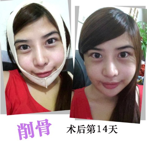 削骨整形 逆袭成回头率百分百 - 珍美网