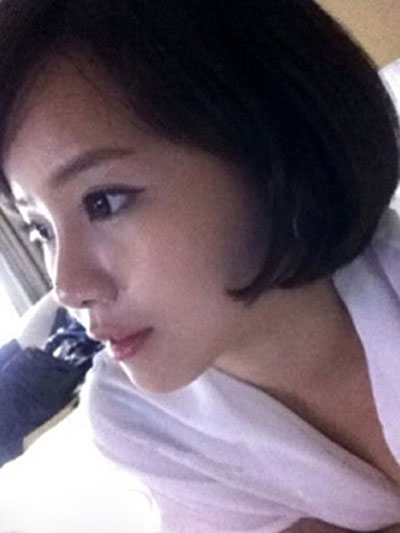 面部脂肪填充术 让自己变得更加清新可爱美丽 - 珍美网