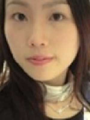 面部脂肪填充 美得更能幸福的生活 - 珍美网