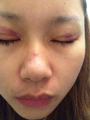 埋线双眼皮 闪亮闪亮大眼睛超迷人 - 珍美网