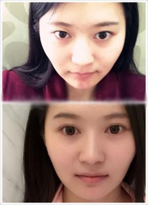 眼部整形 让五官更加清晰美丽