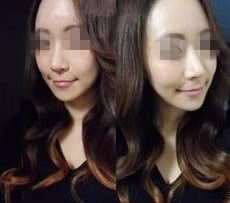 面部整形 实现变成女神愿望