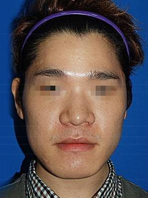 面部整形 屌丝男变男神帅帅哒 - 珍美网