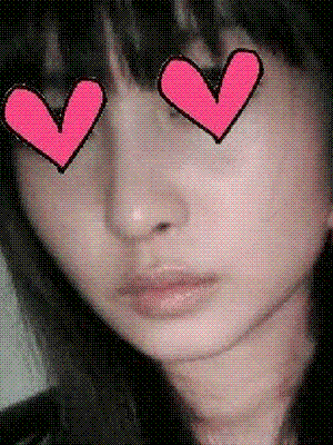 下颌角整形 自拍各个角度都很自信 - 珍美网