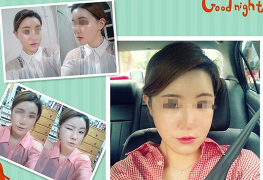 双鄂手术 丑小鸭变白天鹅不是个难事