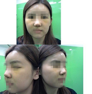 隆鼻整形 蹋鼻女王变高挺鼻女王 - 珍美网