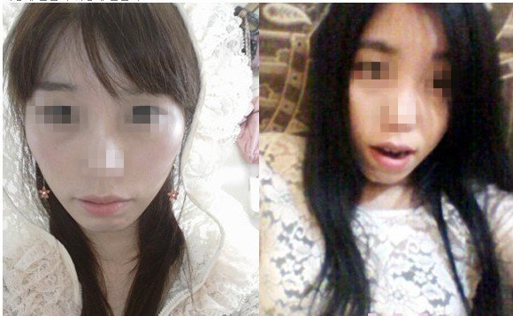 颧骨整形 年轻十岁脸变得更柔和 - 珍美网