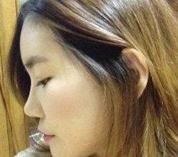 地包天矫正术  实现活泼美丽的自己