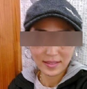 面部脂肪移植 让自己变得更加自信美丽 - 珍美网