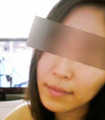 面部脂肪移植 让自己变得更加自信美丽 - 珍美网