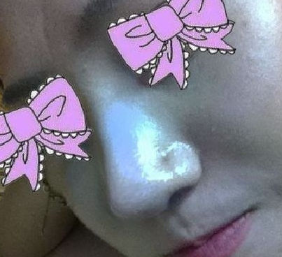 隆鼻手术 让我更加活泼开朗啦