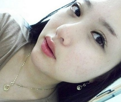 玻尿酸丰下巴  让我侧颜更加靓丽