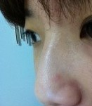 隆鼻手术  更成熟更有魅力了 - 珍美网