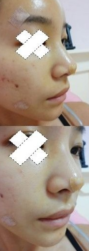 隆鼻手术  更成熟更有魅力了 - 珍美网