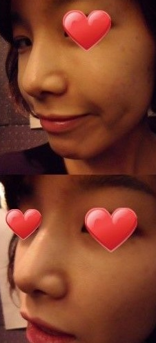 隆鼻手术  更成熟更有魅力了