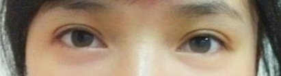 全切双眼皮  眼睛越来越灵动了