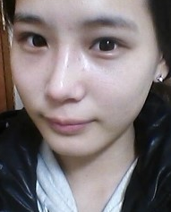 隆鼻手术  让我更加充满信心