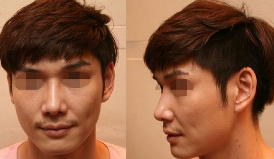 隆鼻手术  我的印象分也大大增值了