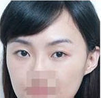 注射玻尿酸  熊猫眼也可以消的干净