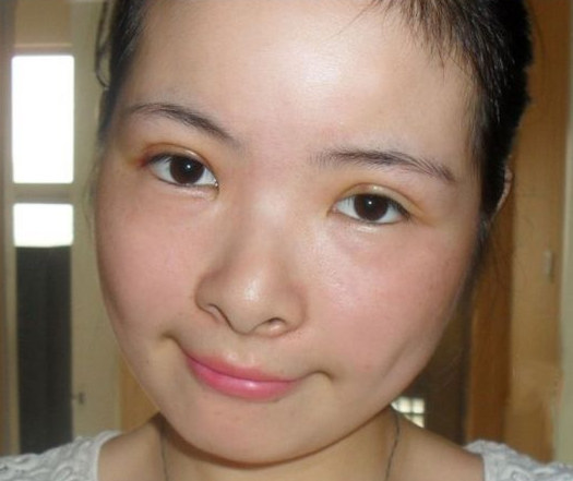 双眼皮手术 我也可以拥有明亮大眼睛啦