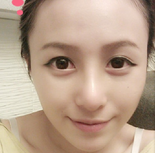 耳软骨隆鼻  显得整体面部更加气质啦