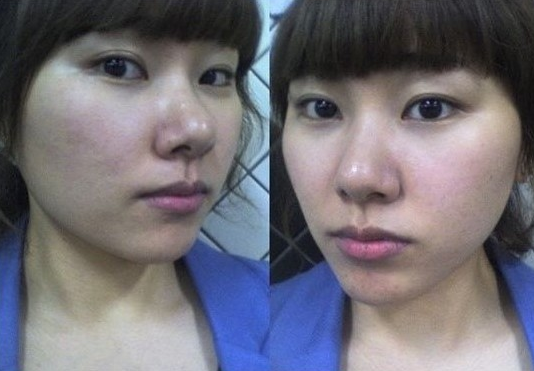 下颌角手术  精致小脸我也可以拥有 - 珍美网