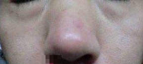 红光+敷药 希望脸蛋能够健康色