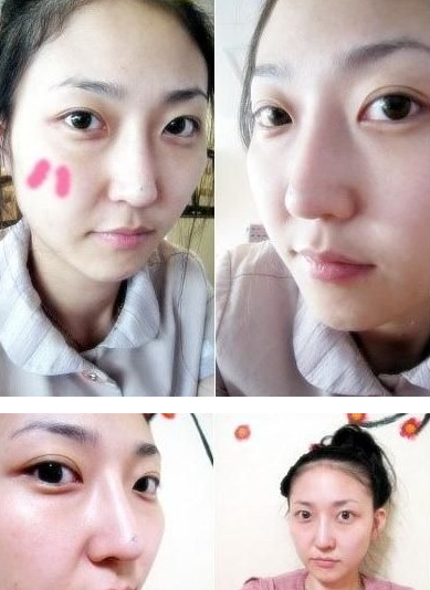 鹰钩鼻整形 五官变得更加立体美丽