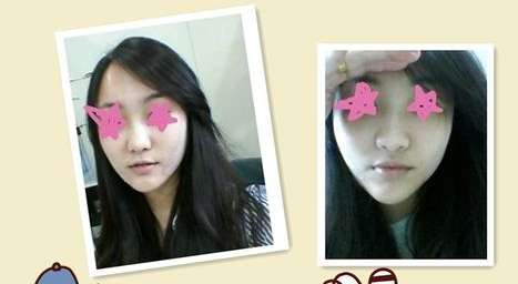 面部提升术  上镜美丽脸型更加精致