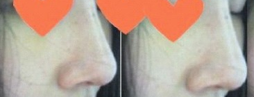 鹰钩鼻整形  让我的侧颜更加美腻