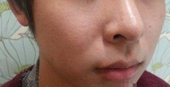 假体垫下巴  真是越来越帅气了呢 - 珍美网