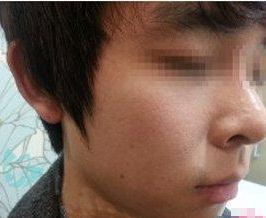 假体垫下巴  真是越来越帅气了呢 - 珍美网