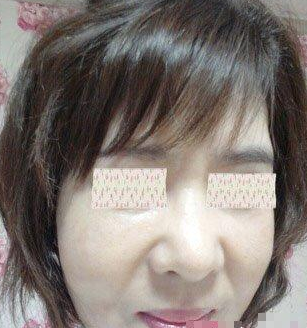 面部皱纹施术  重返年轻不是梦啊 - 珍美网