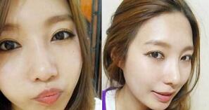 全切双眼皮  让我的人生更加绚丽多彩 - 珍美网