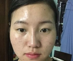 苏州工业园区瑞芙臣医疗美容诊所徐增亮医生丰全脸案例:面部填充 - 珍美网