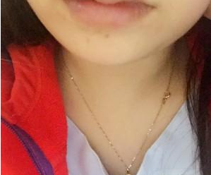 长沙雅美医疗美容医院袁妍妍医生丰唇案例：嘟嘟唇 - 珍美网