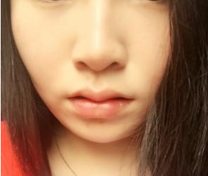 长沙雅美医疗美容医院袁妍妍医生丰唇案例：嘟嘟唇